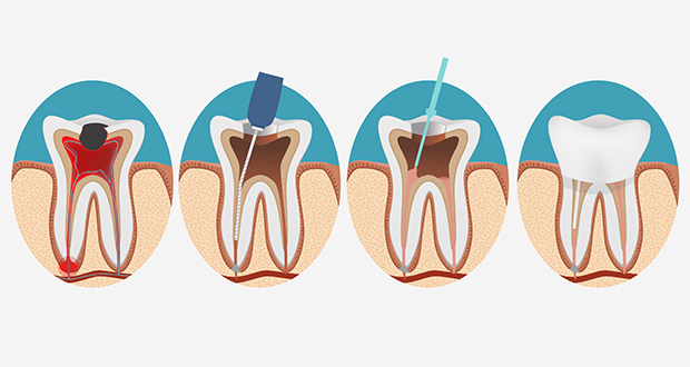 root-canal