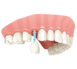 extractions