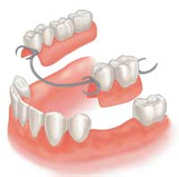 partial-denture